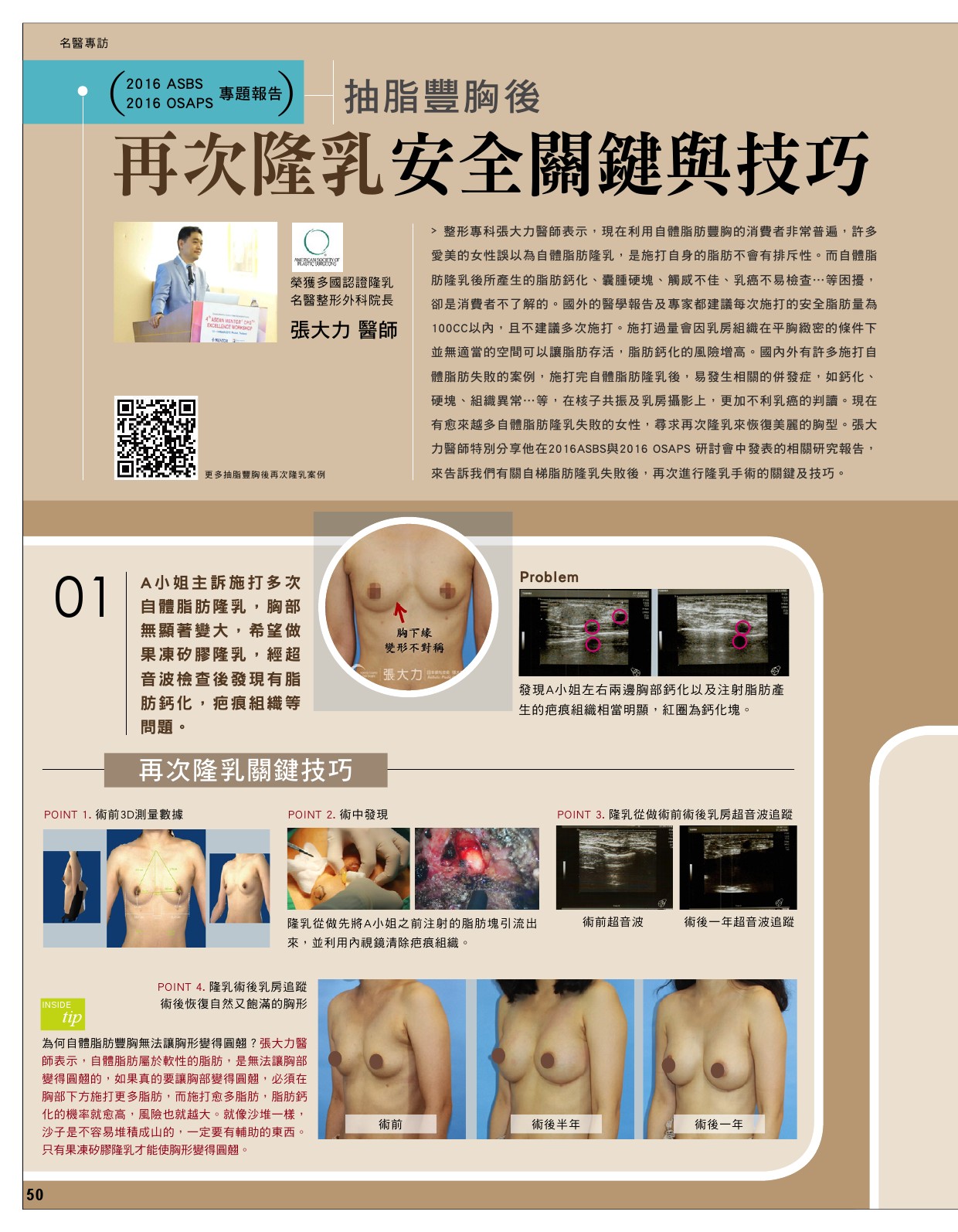 抽脂豐胸後 再次隆乳安全關鍵與技巧-雜誌專訪-張大力-整形名醫-東京風采