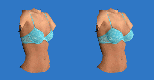 透過3D Vectra影像模擬評估後，您可以於隆乳手術前後真實與全方位比較-東京風采整形外科診所