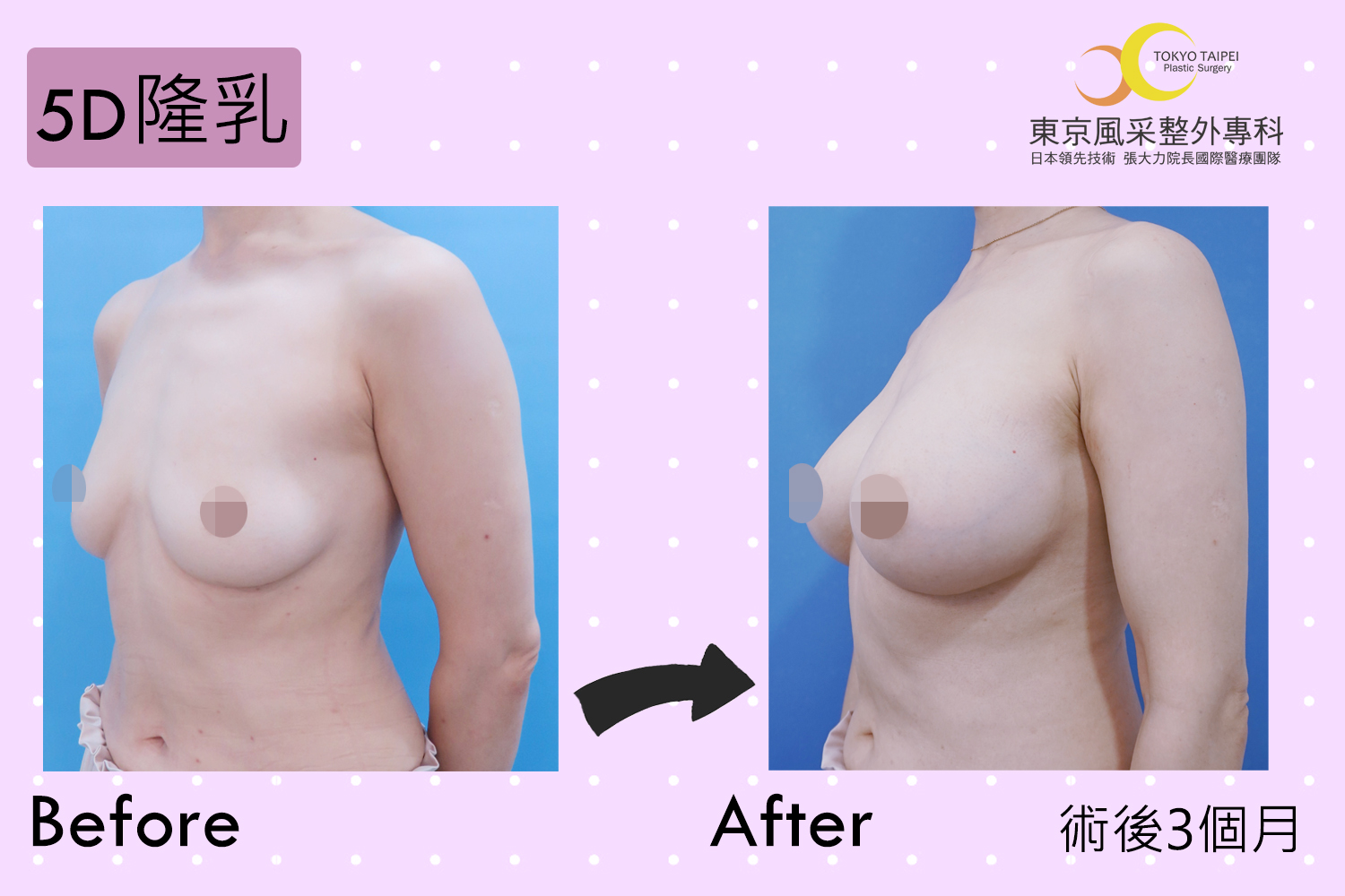 5D隆乳手術前後-東京風采整形外科診所