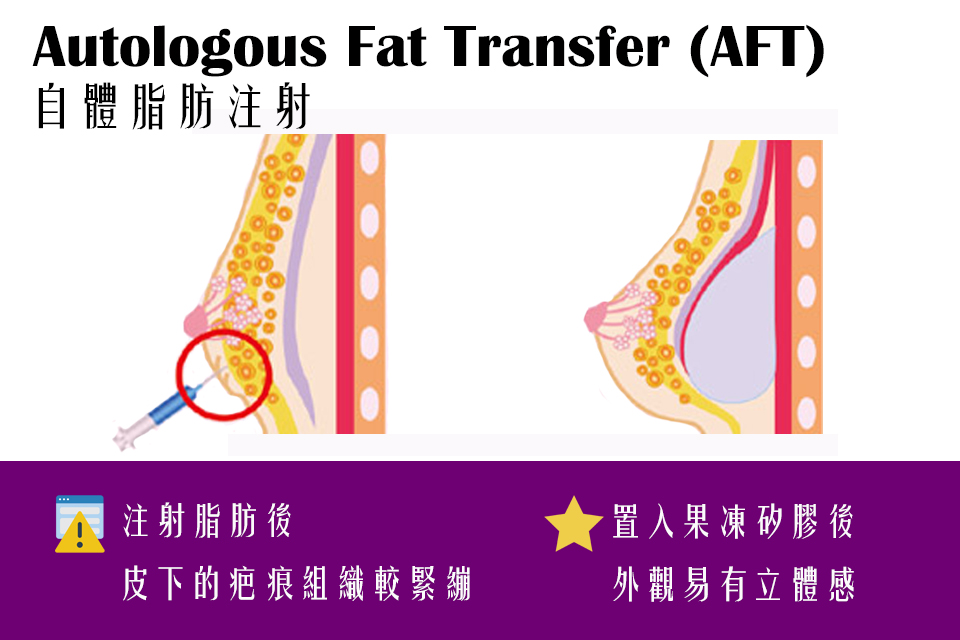 自體脂肪隆乳手術流程介紹-東京風采整形