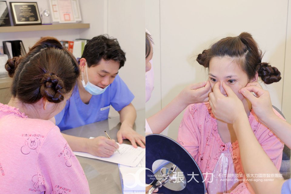 縫合式雙眼皮手術